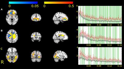 Altered Resting State Functional Activity and Microstructure of the White Matter in Migraine With Aura